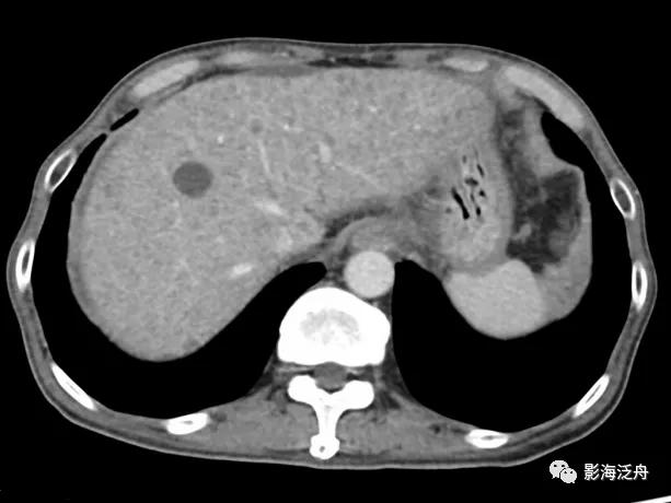 肝脏弥漫性病变严重吗,肝脏弥漫性的病变的症状
