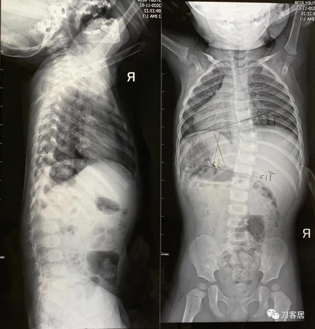 我的门诊病历：家族性神经纤维瘤病性脊柱侧凸