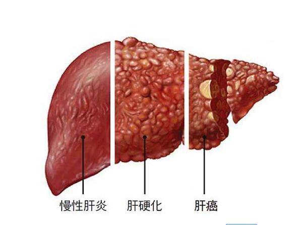 肝癌喝中药肿瘤缩小又转移了,早期肝癌喝中药肿瘤缩小了