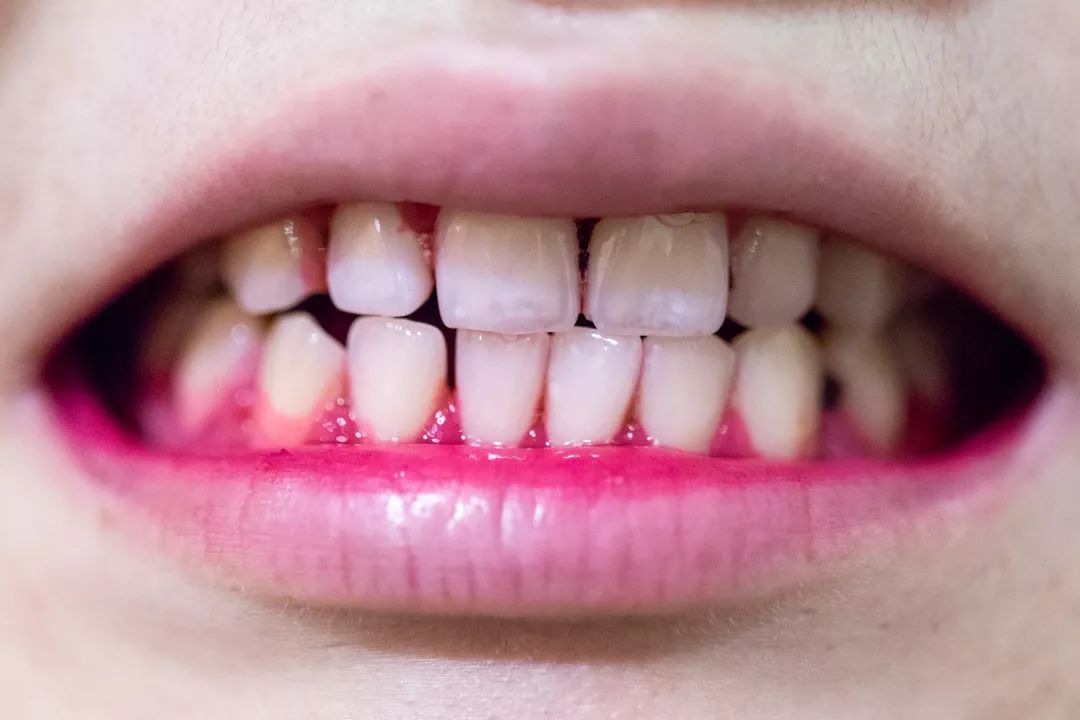 最好用的洗大黄牙的牙膏,马卡龙牙膏去牙垢方法