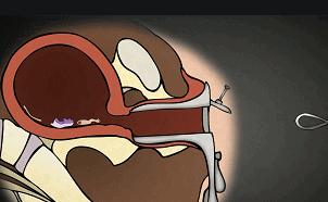 三分钟无痛人流的原理,三分钟无痛人流