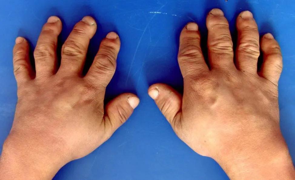 大骨节病科普视频,关于膝盖痛你了解多少