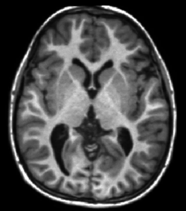 磁共振怎么看大脑基底节区和丘脑,脑核磁能不能看清楚骨头