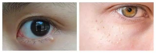 脸上长脂肪粒3个小妙招去除,脸上长了脂肪粒怎么消掉