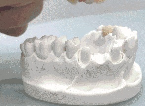 种植牙与烤瓷牙的区别,烤瓷牙和种植牙到底有何区别