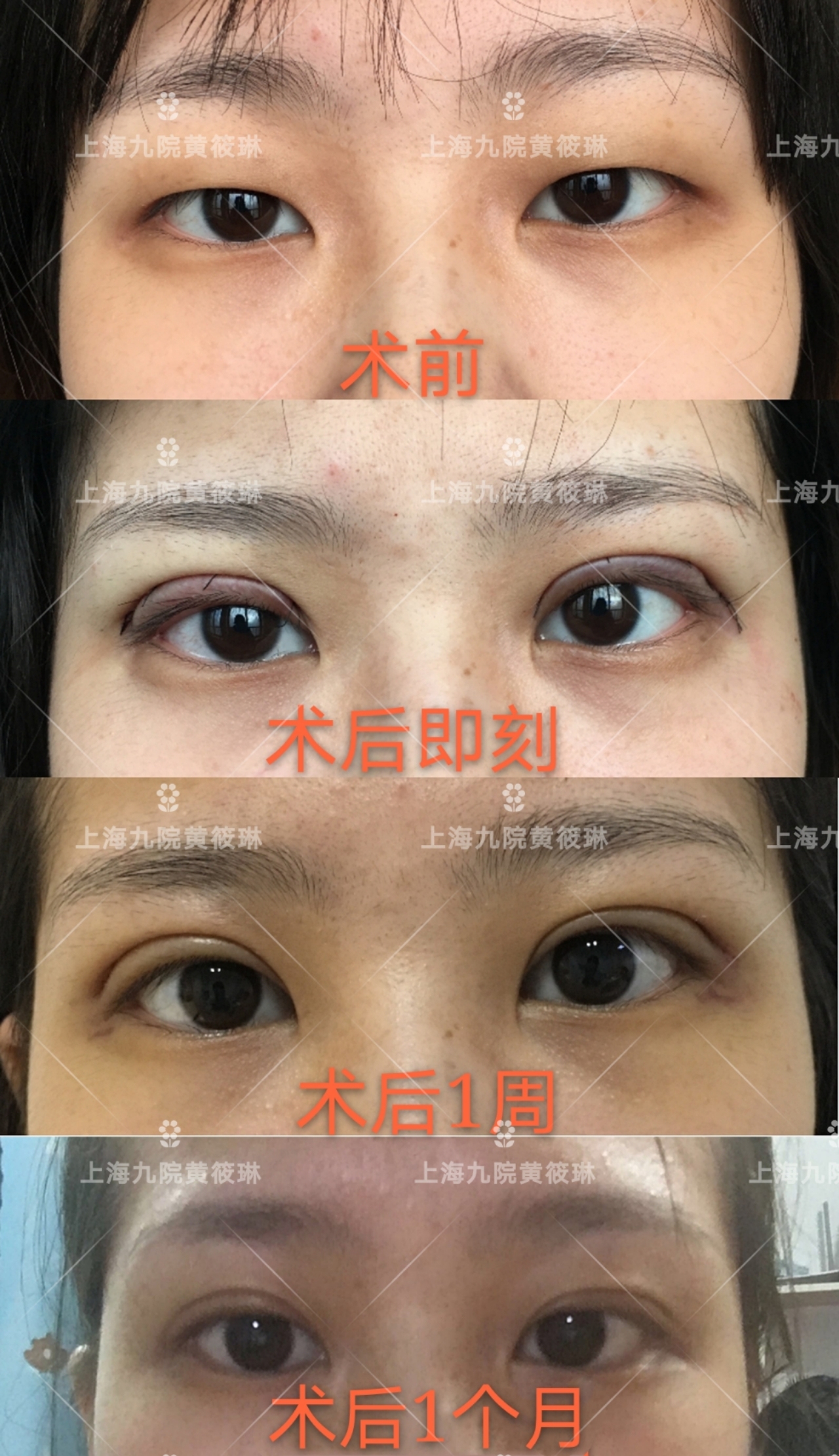 双眼皮消肿以后还是变宽,双眼皮吃什么药消肿比较快