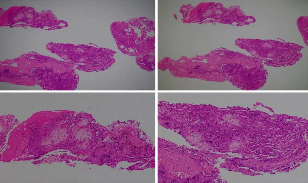 机化性肺炎必须病理确诊吗,机化性肺炎好转的征兆