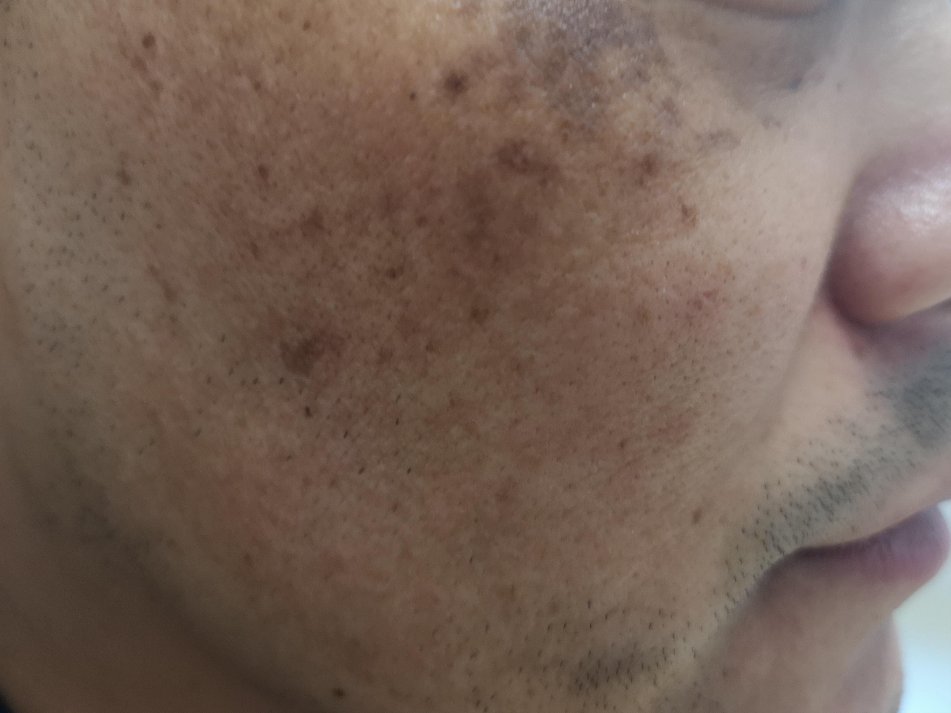 斑需要如何治疗,斑多如何调理