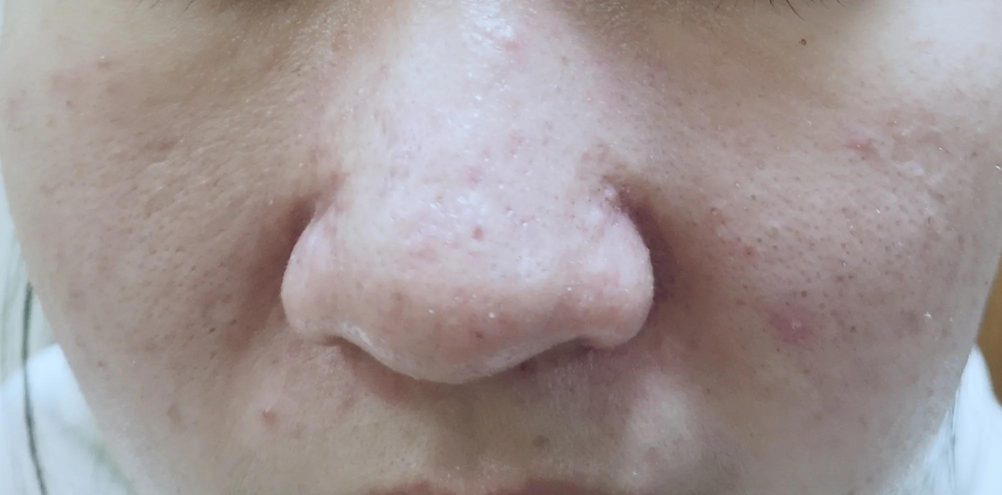 快来月经时下巴长包怎么回事,快来月经下巴下颚老是长痘