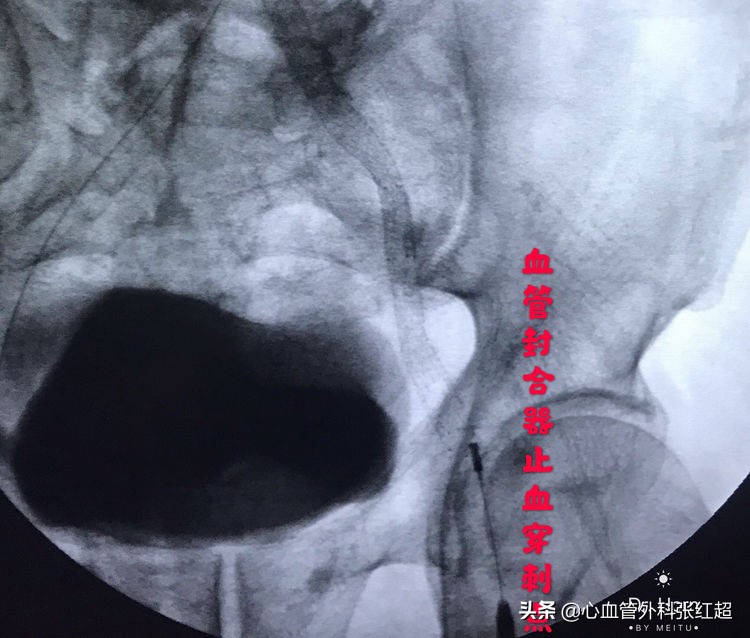 外周血管治疗图,外周血管疾病怎么治