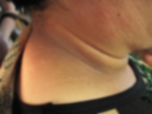 多囊，为什么有卵子不能排出？