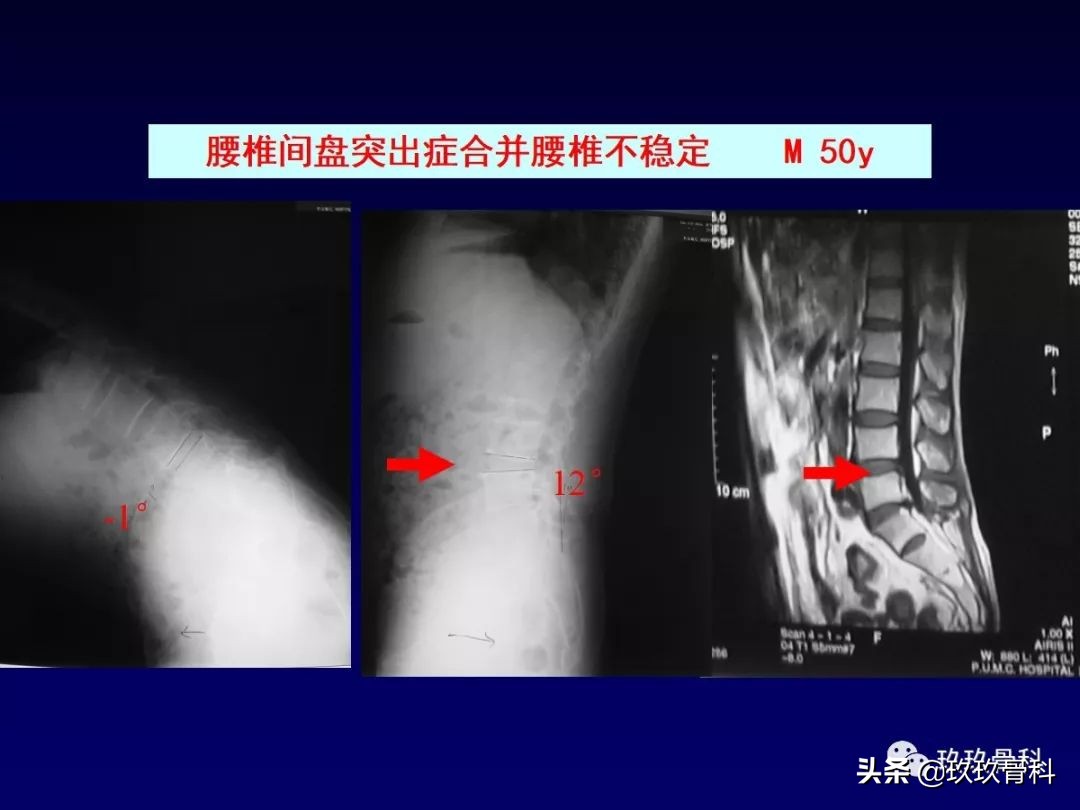 腰椎不稳最坏的结果,腰椎不稳的最佳治疗方法