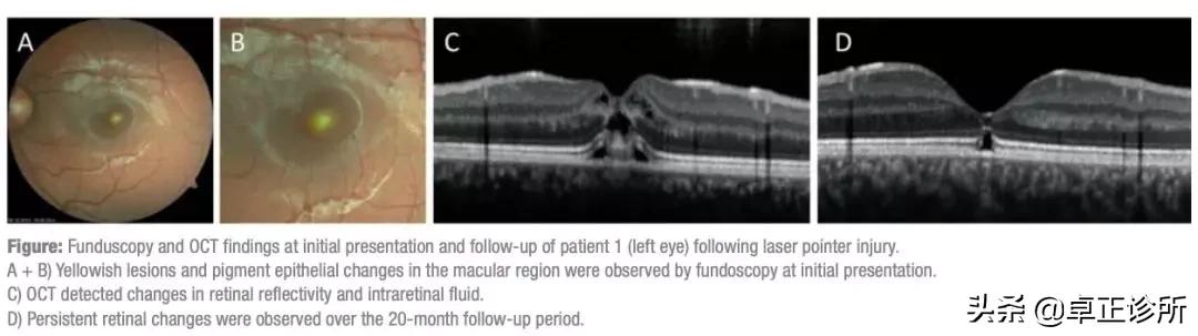 红外线对眼睛的伤害是持续性的吗,红外线额温枪照射眼睛会怎么样