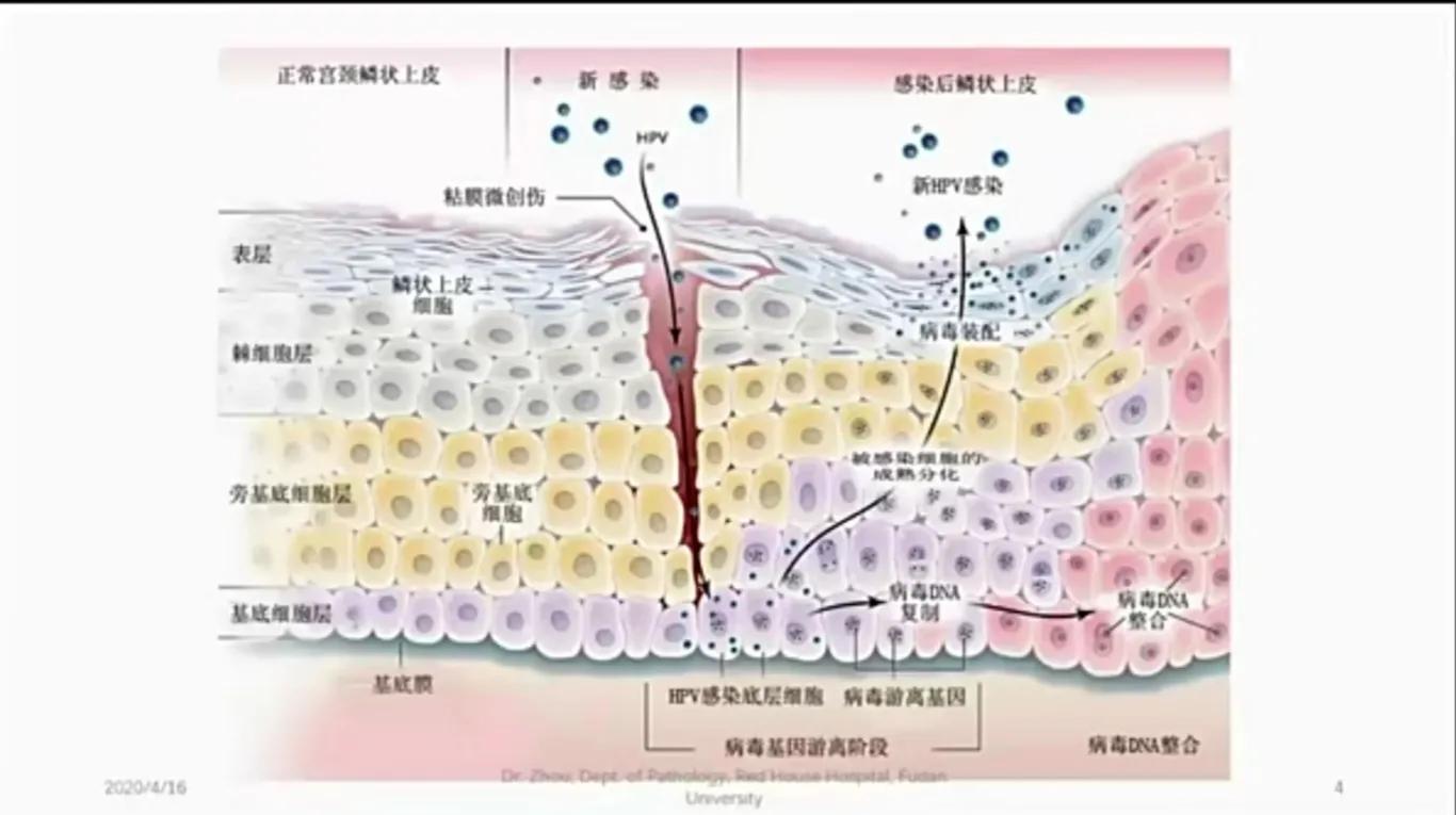 宫颈低级别鳞状上皮病变LSILCIN1,宫颈鳞状上皮内病变lsil是什么