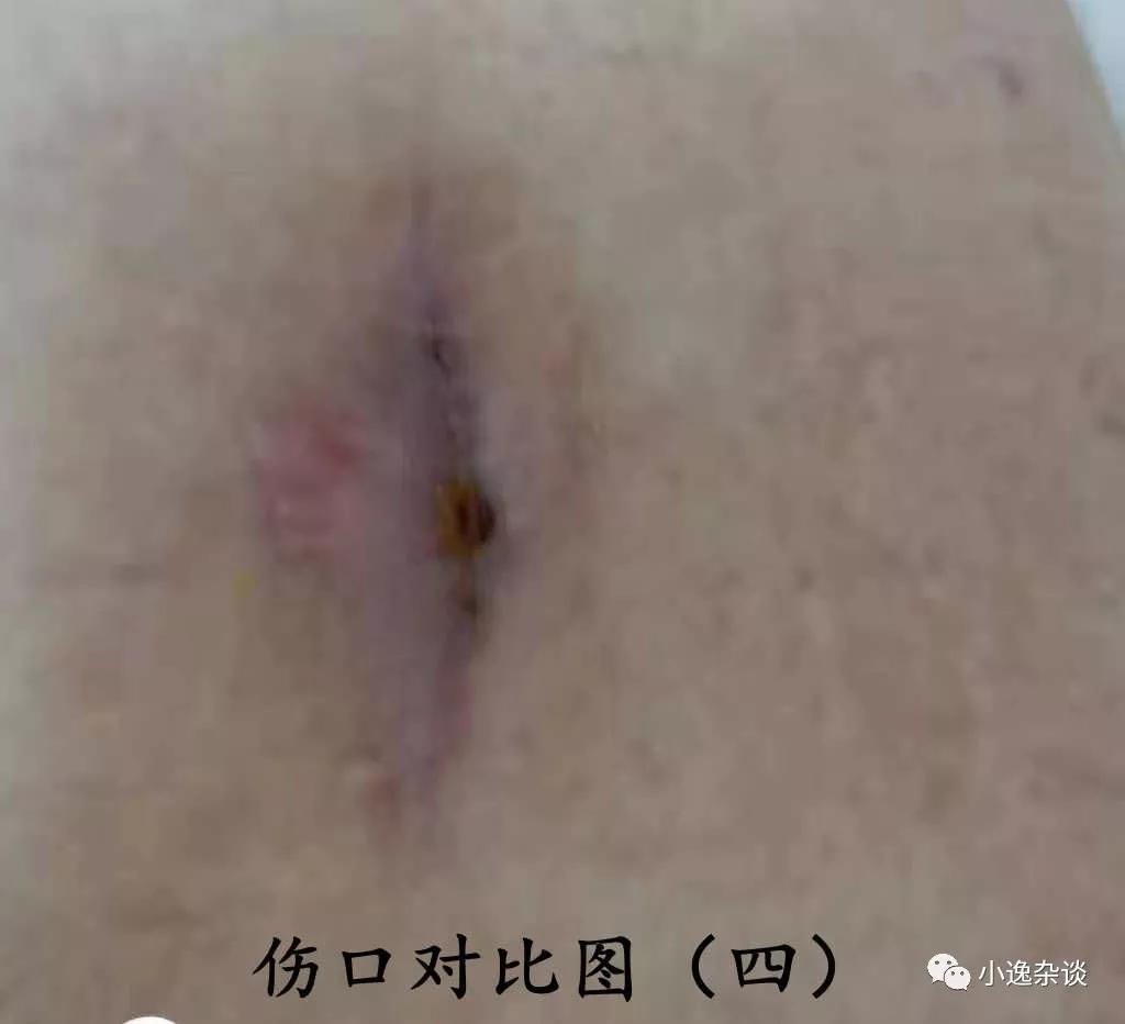 皮肌炎回忆录（十）