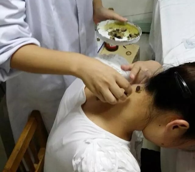 周楣声灸法理论,周楣声谈吹灸