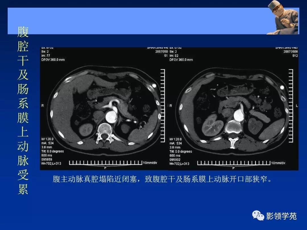 主动脉夹层壁间血肿如何鉴别,主动脉夹层血肿溃疡