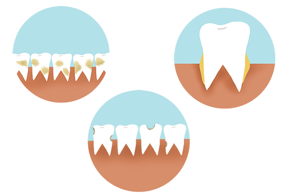 没有牙结石洗牙的清理步骤,自己在家洗牙去牙结石