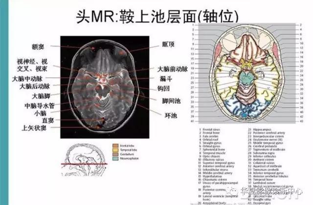 电子版头颅ct与mri断层解剖,头颅mri血管解剖与分段详解