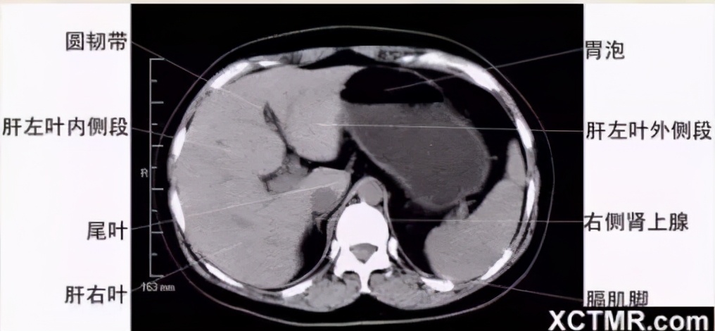 女性盆腔ct断层解剖结构图,女性盆腔脏器ct解剖