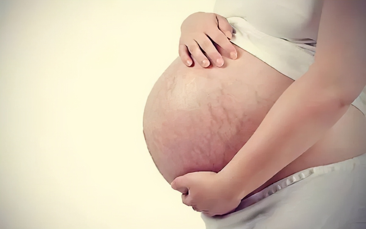 肥胖纹和妊娠纹消除方法,肥胖纹妊娠纹怎么消除