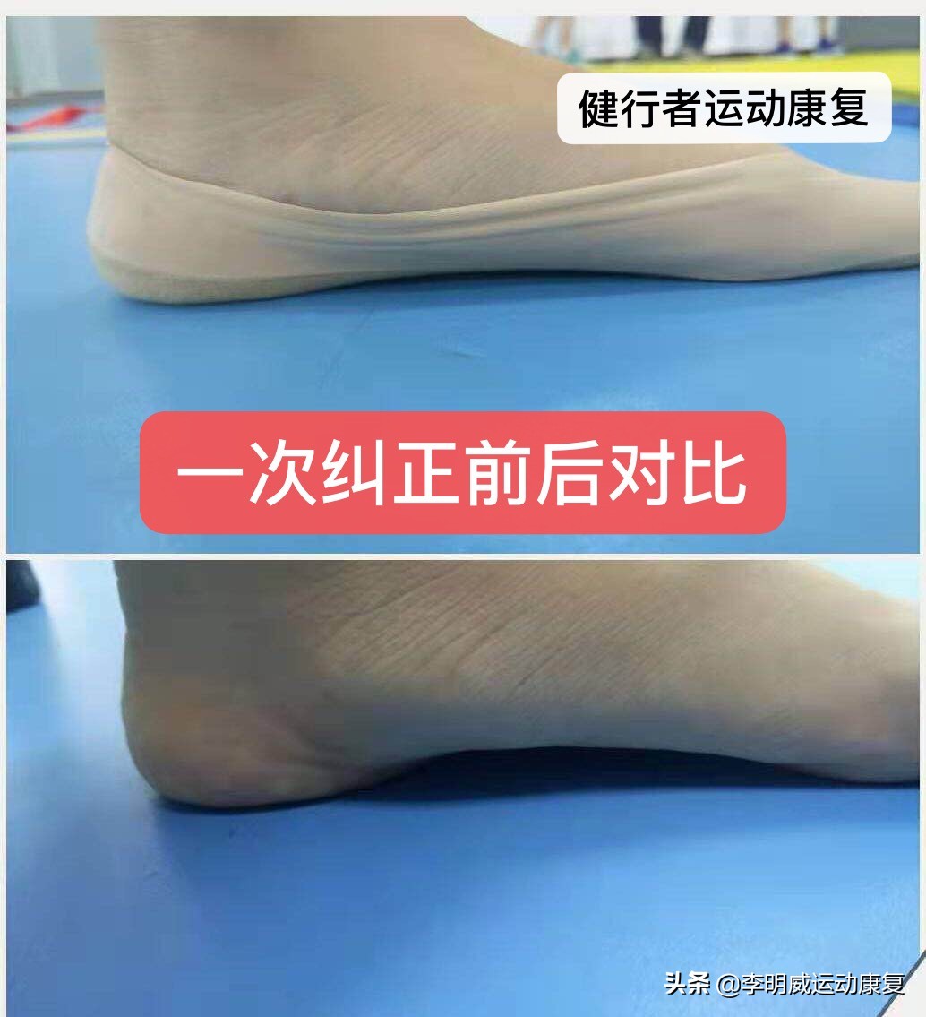 骨盆不正导致腿不直,骨盆不正导致的长短腿症状