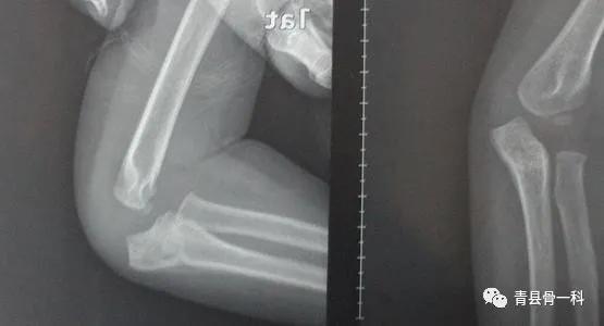 小孩骨折怎么判断,怎么判断是新骨折还是陈旧骨折