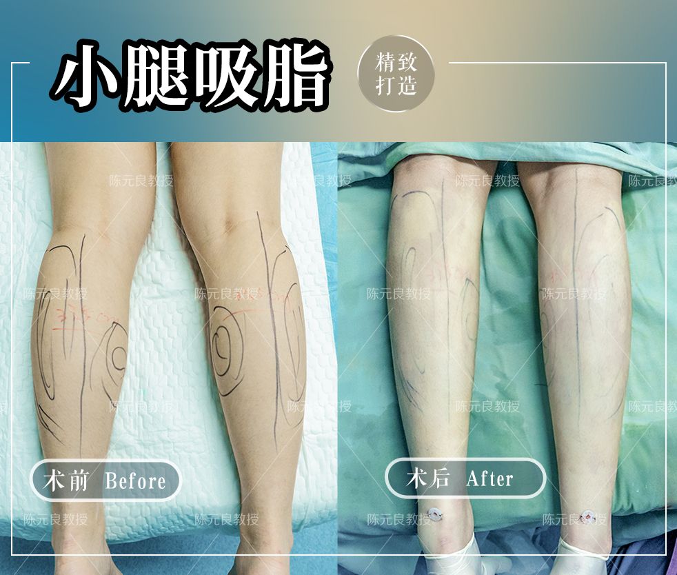 大小腿吸脂半个月小腿一碰就痛,小腿吸脂可以瘦几厘米