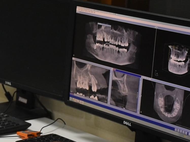 做烤瓷牙导致整口牙坏掉?真实案例给你提醒