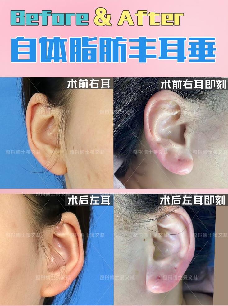 怎样让耳垂变得又厚又好看,耳垂小怎么化解