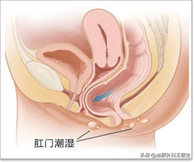 肛门潮湿瘙痒是体湿吗,湿气重也能引起肛门外潮湿瘙痒吗