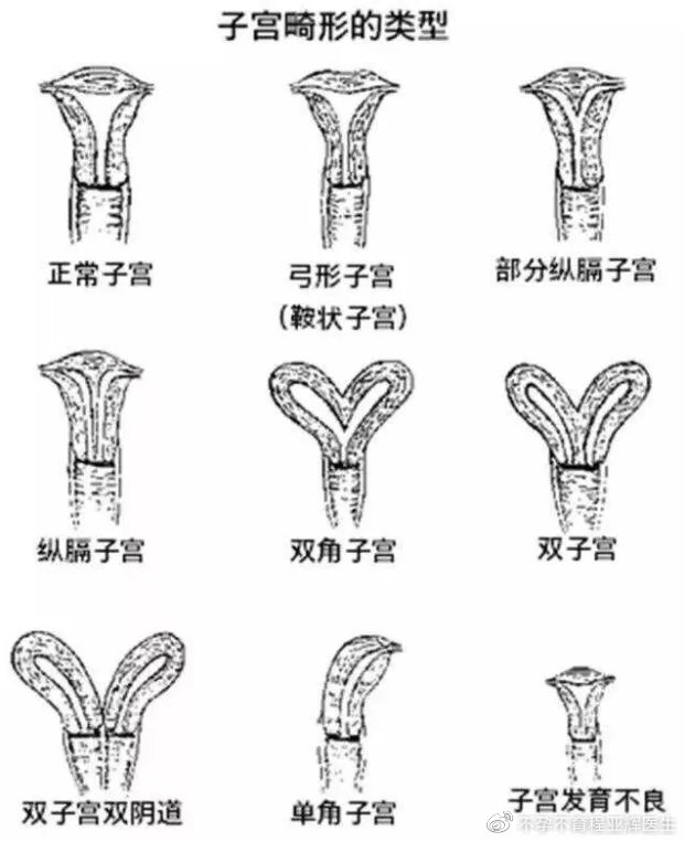 子宫畸形胎儿能正常发育吗,畸形精能正常怀孕吗