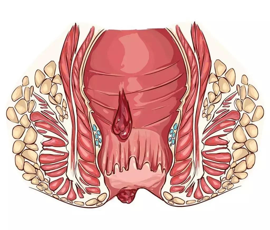 孕妇使用痔疮膏导致流产,怀孕时用麝香痔疮膏会流产吗