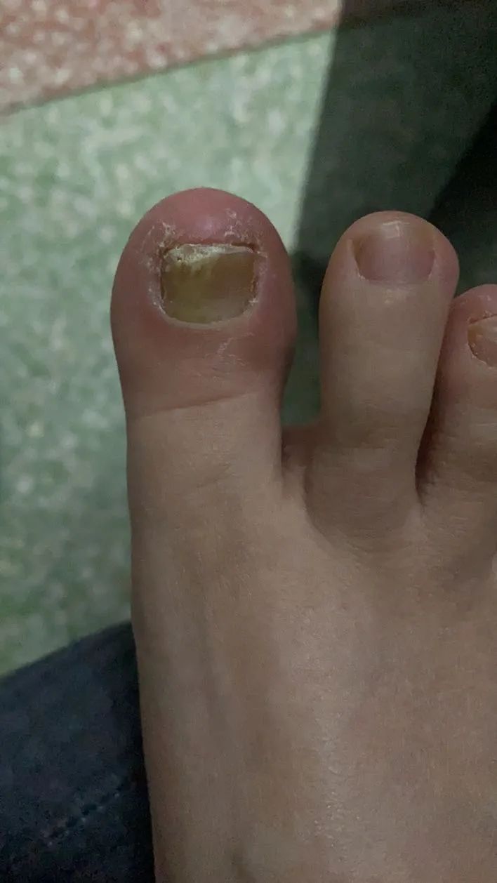 家里治脚气最好的方法,家庭治脚气的最好方法