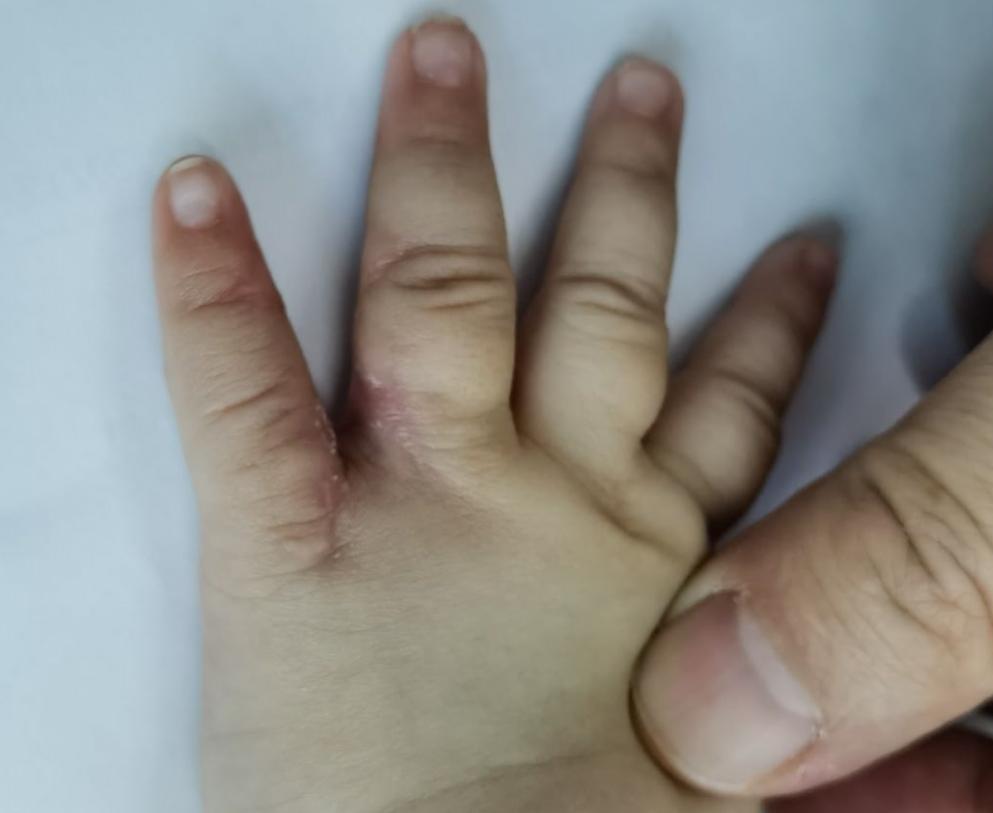 并指畸形免植皮案例,并指畸形