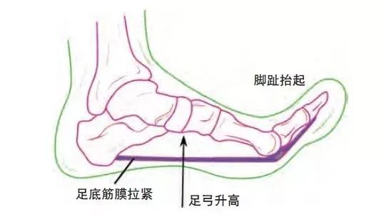 跑步跑到足跟痛，运动生涯要报废？