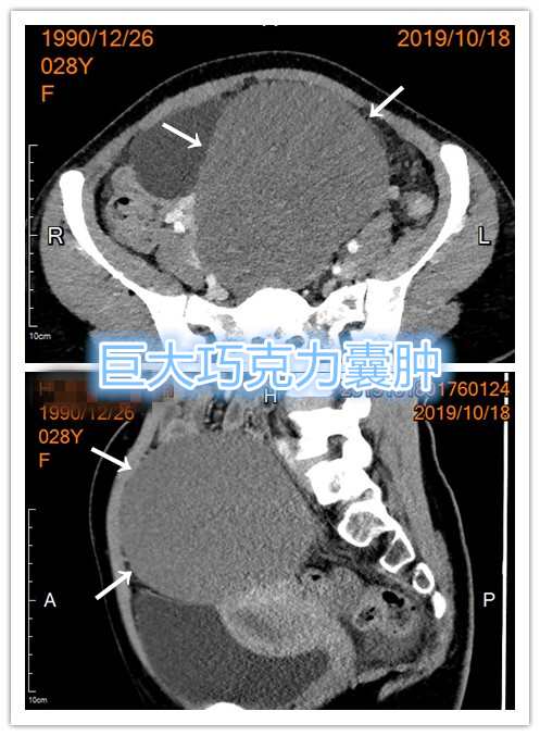 介入栓塞治疗巧克力囊肿,介入超声治巧克力囊肿需要多久