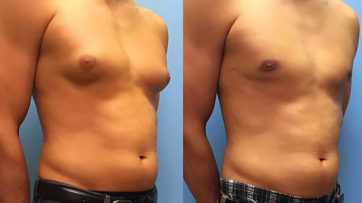 男性乳房发育在家如何治疗,男性乳房发育导致腋下不舒服