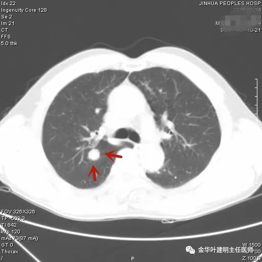 叶建明谈胸膜下的实性结节,叶建明肺实性良性结节会变癌症吗
