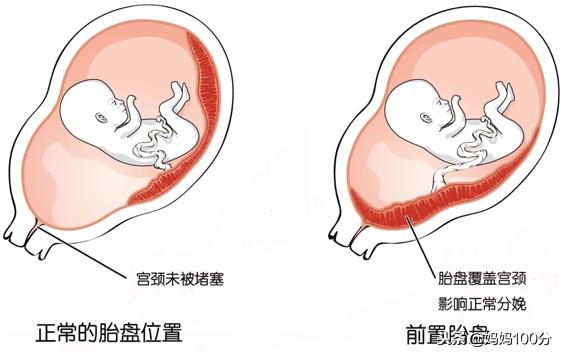 剖宫产还是顺产，该由谁做选择？