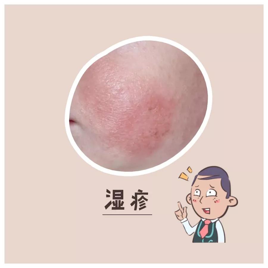 热天痱子怎么治,热天有痱子用什么最好