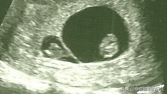 上次检查还好好的双胞胎,这次咋就变单胎了?我的胎儿去哪儿了?