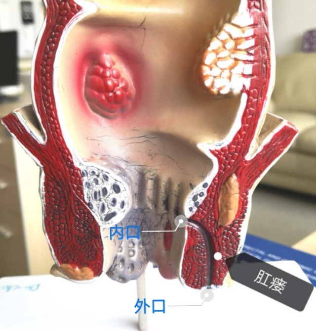 肛瘘内口愈合了还要不要做手术,肛瘘手术当天要不要人照顾