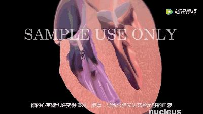 支架后病人还能活多久,支架手术后恢复锻炼分几级