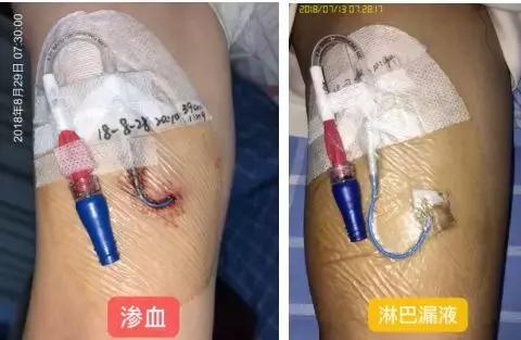 护士picc导管维护,护士picc相关知识薄弱