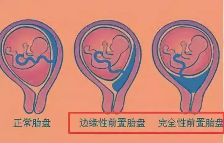 妇科b超能查出有没有宫腔粘连吗,孕期做b超能检查出来什么