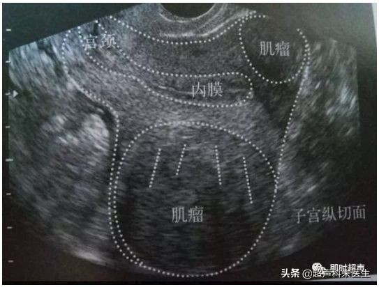 妇科超声的标准超声图,妇科超声图解