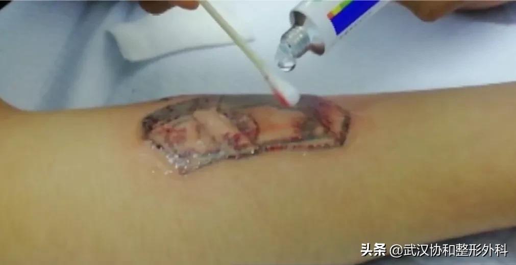 激光洗纹身出血吗,洗纹身是什么体验