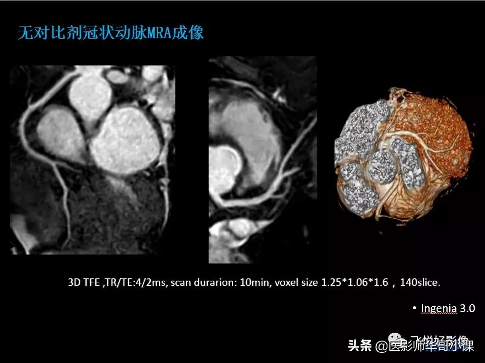 飞利浦核磁共振快速扫描,飞利浦磁共振心脏扫描