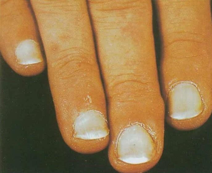 指甲问题对应身体哪里有问题,指甲的各种病变及解决办法